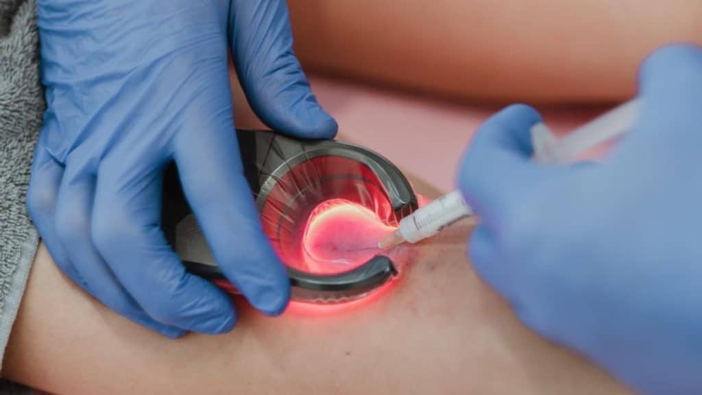 tratamiento varices sin cirugia mallorca