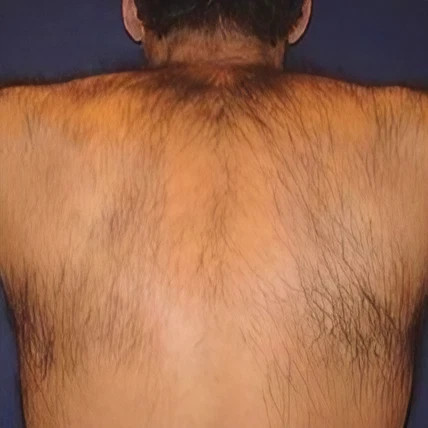 laser soprano hombre antes