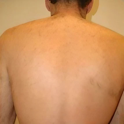 laser soprano hombre después