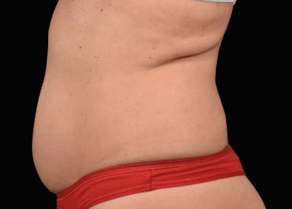 Emsculpt neo despues